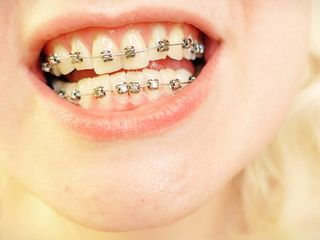 braces mouth excursion video – vore fetish
