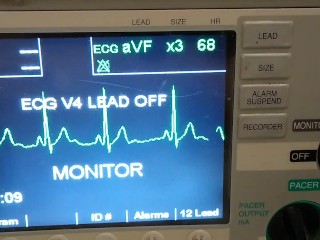 EKG of my middle with a needle in it